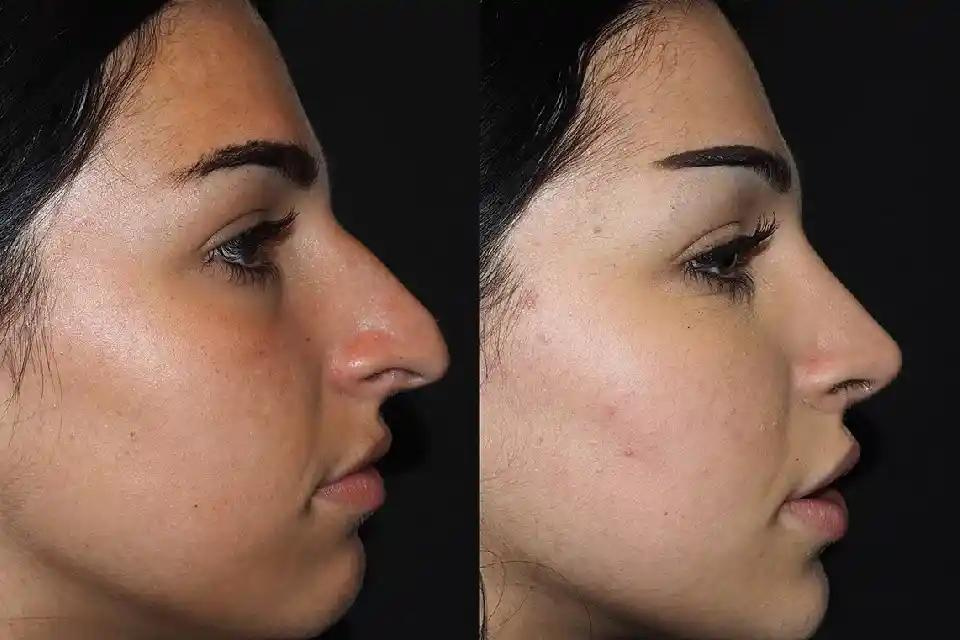 What is Rhinoplasty in Dubai?